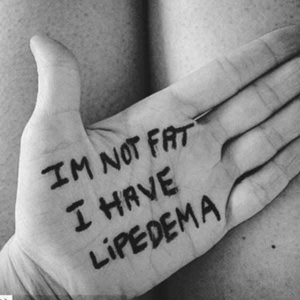 9 Cosas que has de saber sobre el Lipedema