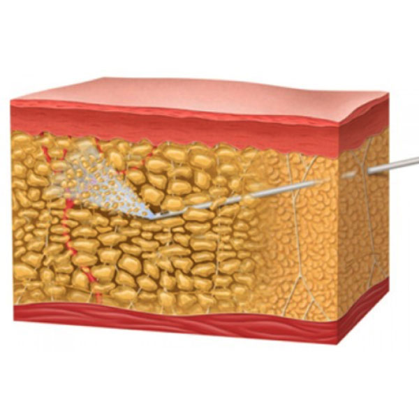 Water assisted liposuction (wal) en el tratamiento del lipedema