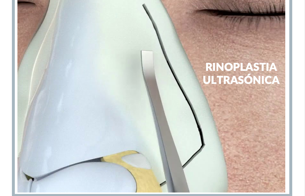 Rinoplastia ultrasónica en Barcelona