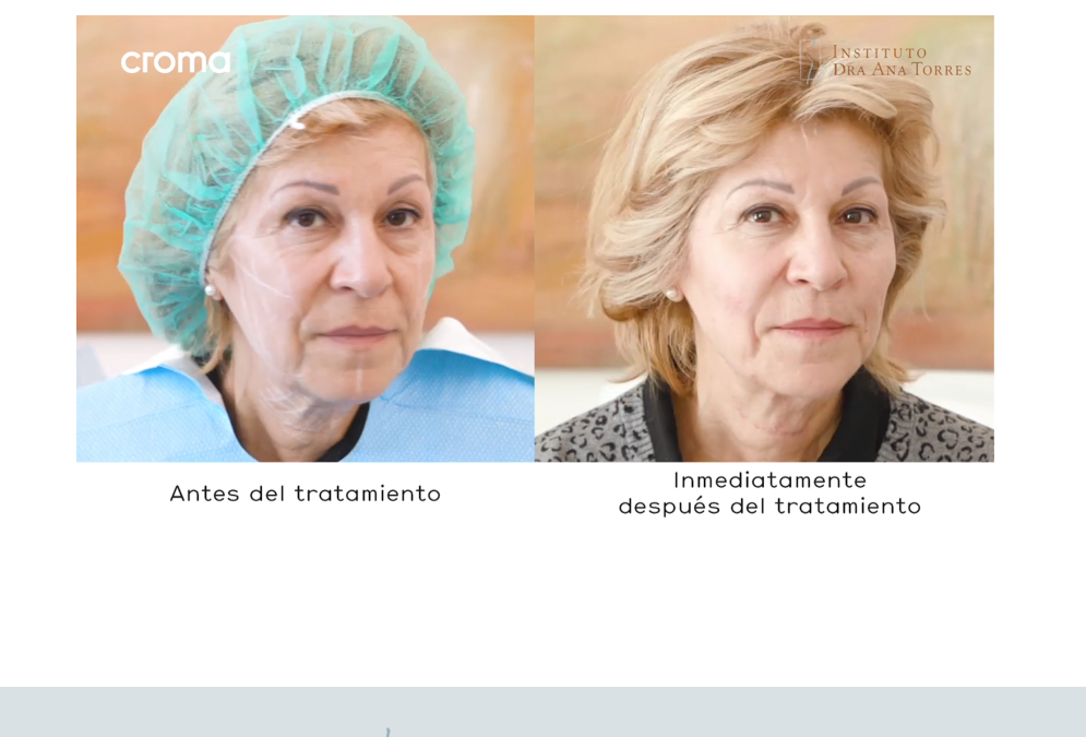 Tratamientos para la flacidez de cara y Cuello: Los hilos tensores