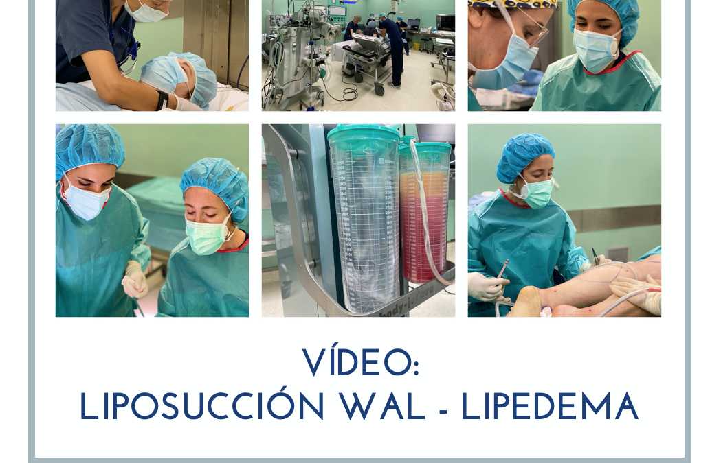 Tratamiento quirúrgico del Lipedema con Liposucción WAL en Barcelona